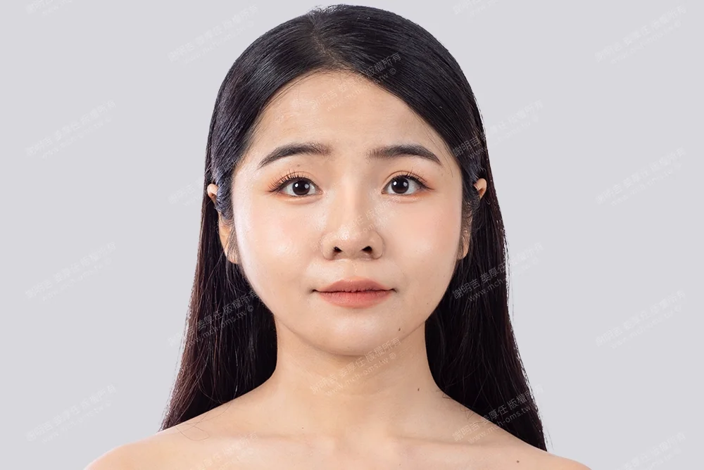 削骨手術、下巴雕塑