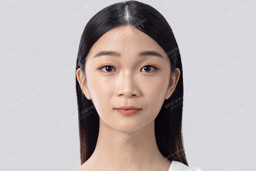 女性柔化、額頭雕塑手術、削骨手術