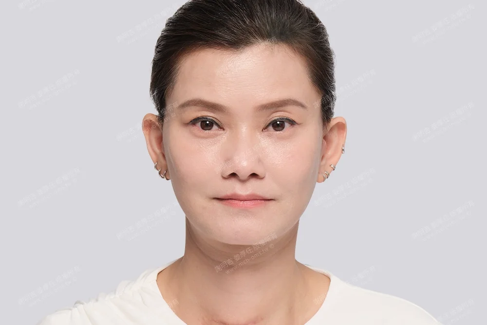 拉皮手術